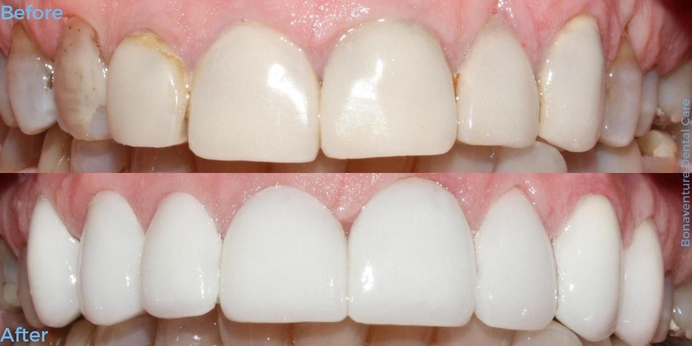 Dentist in Baton Rouge Smile Makeover Before and after treatment at Bonaventure Dental Care