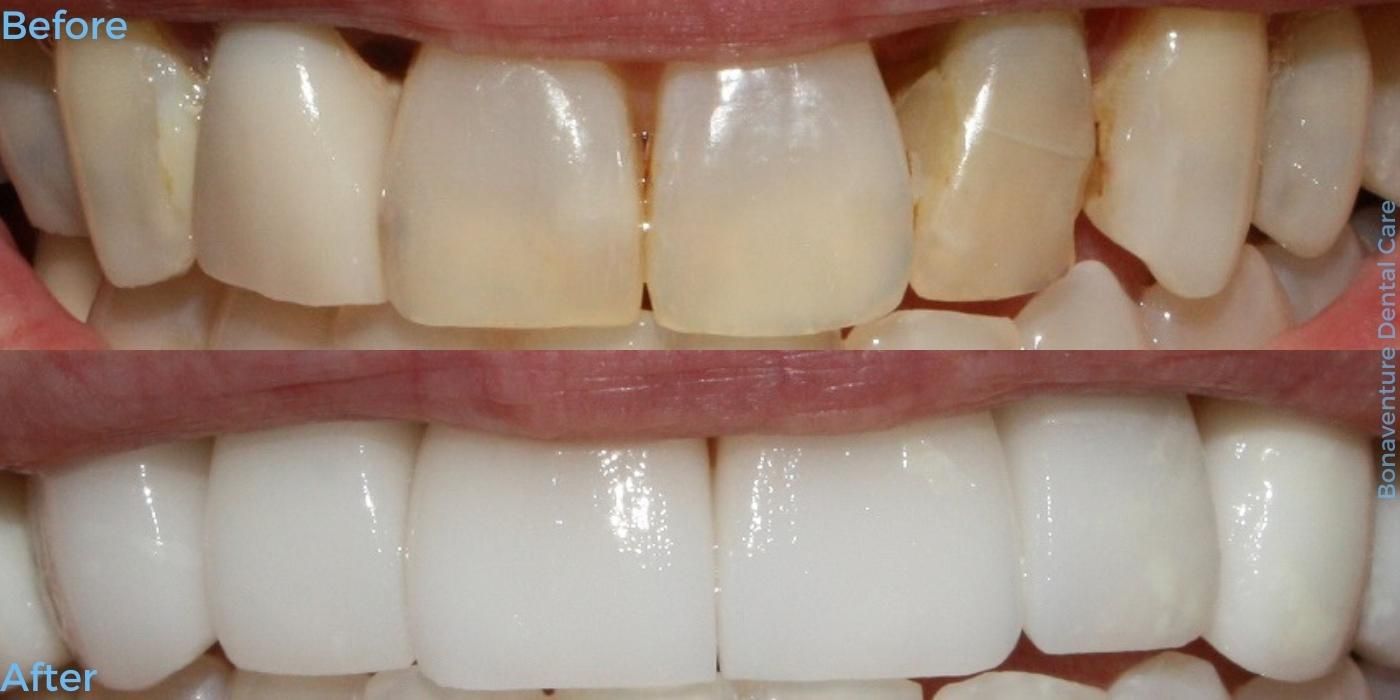 Dentist in Baton Rouge Smile Makeover Before and after treatment at Bonaventure Dental Care
