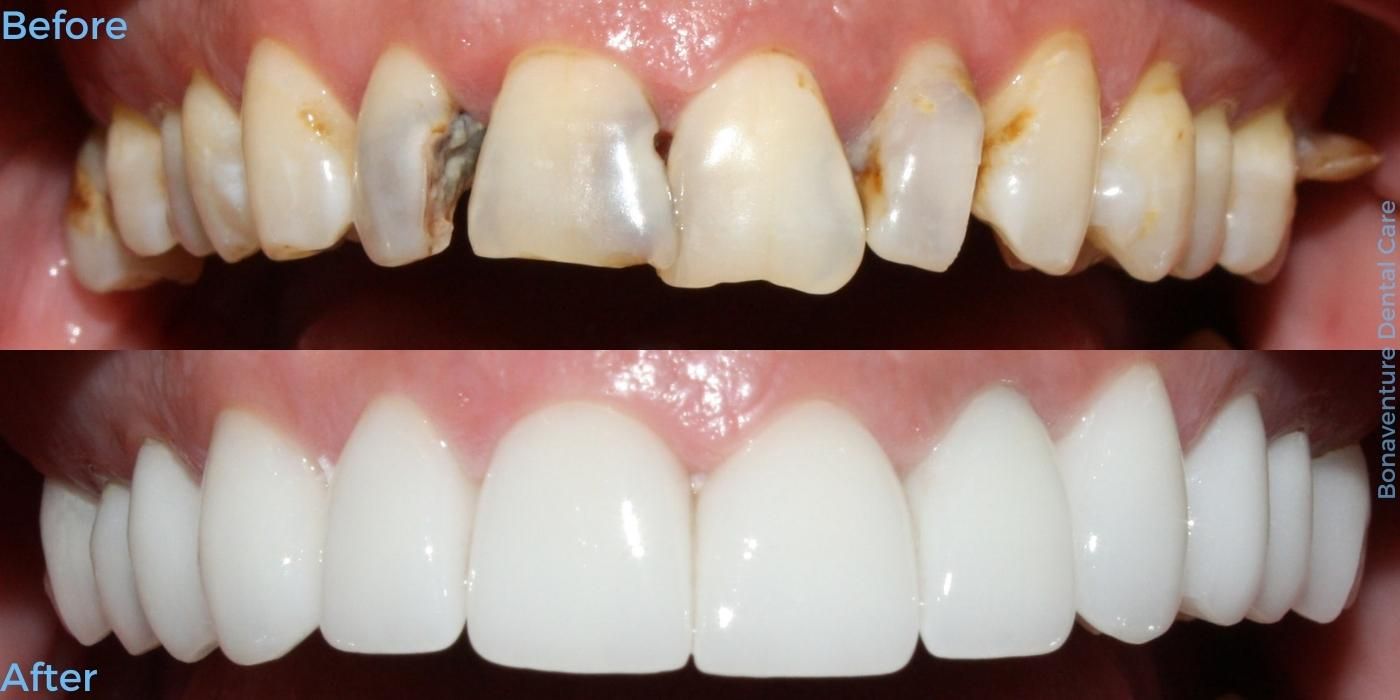 Dentist in Baton Rouge Smile Makeover Before and after treatment at Bonaventure Dental Care